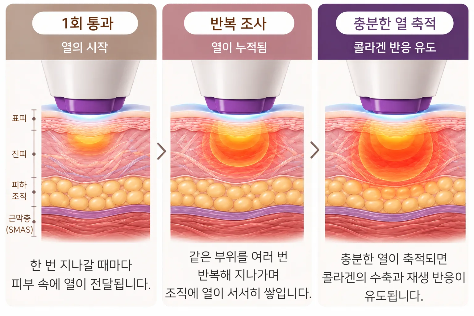 써마지 핸드피스로 같은 부위를 반복해 지나가며 진피에 열이 점차 넓게 쌓이고 콜라겐 반응이 유도되는 과정을 3단계 피부 단면으로 나타낸 그림